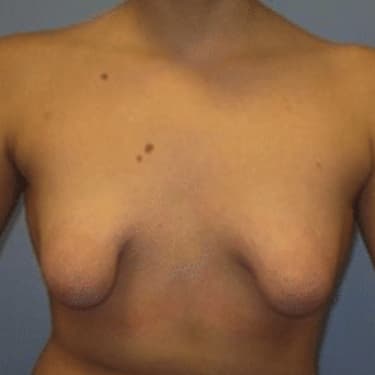 tuberous breast