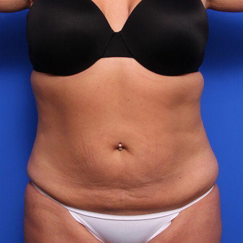 before and after liposuction