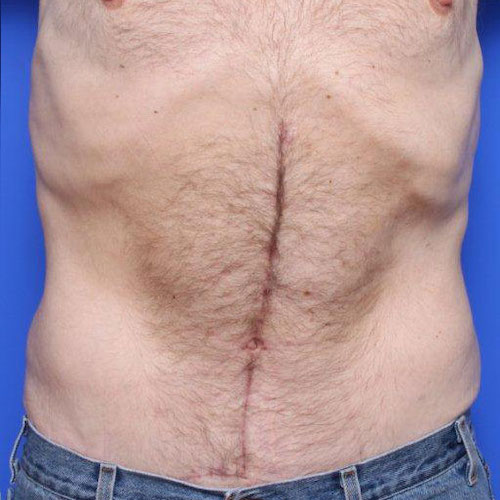 before and after tummy tuck