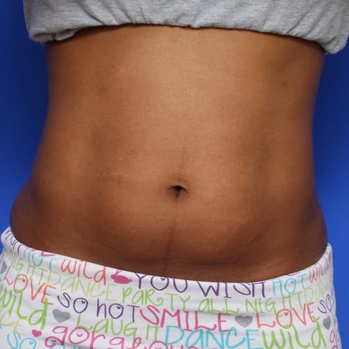before & after coolsculpting