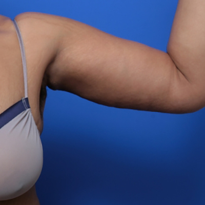 before and after arm lift