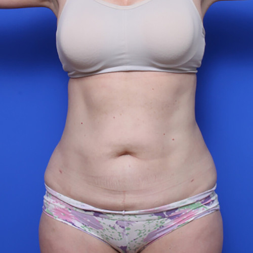 before and after liposuction