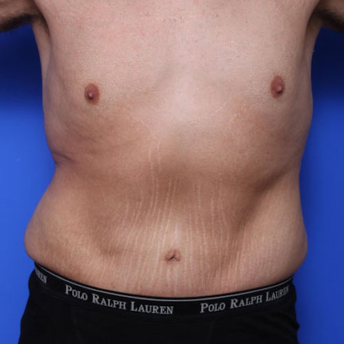 before and after tummy tuck