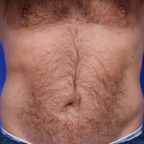 before & after coolsculpting