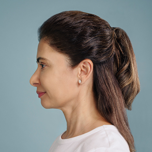 before and after filler