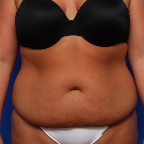 before and after liposuction