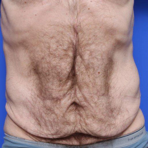 before and after tummy tuck