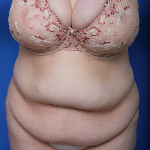 before and after mommy makeover