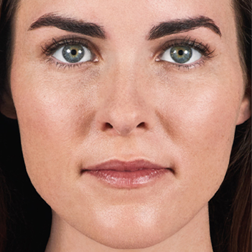 Lip Injections Baltimore Lip Filler Columbia MD Dr. Mess