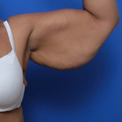 before and after arm lift
