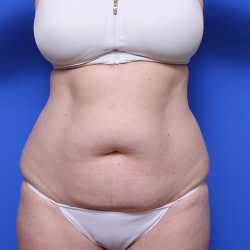 before and after liposuction