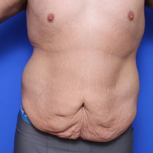 before and after tummy tuck