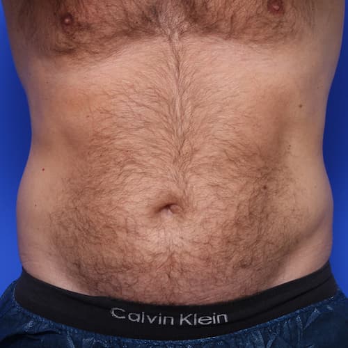 before & after coolsculpting