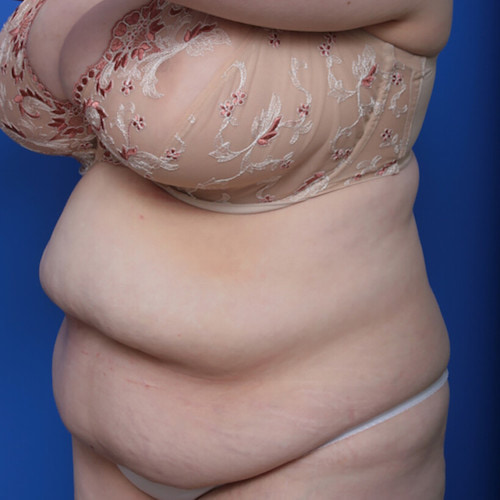 before and after mommy makeover