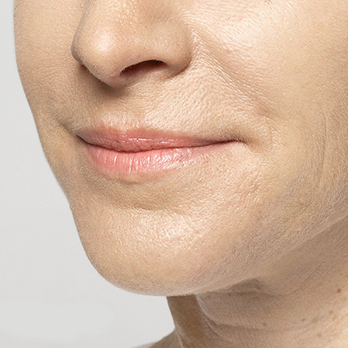 before and after lip filler