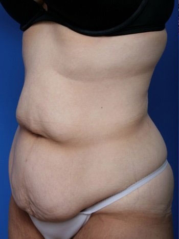before and after body lift