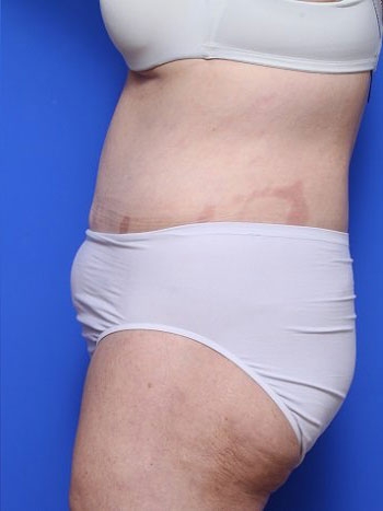 before and after body lift