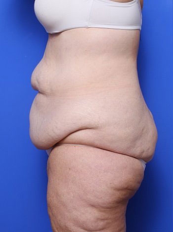 before and after body lift