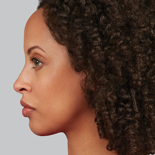 side view of a women after juvederm treatment