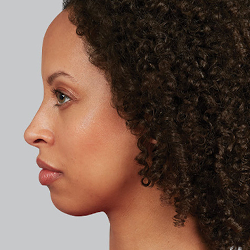 side view of a women before juvederm treatment