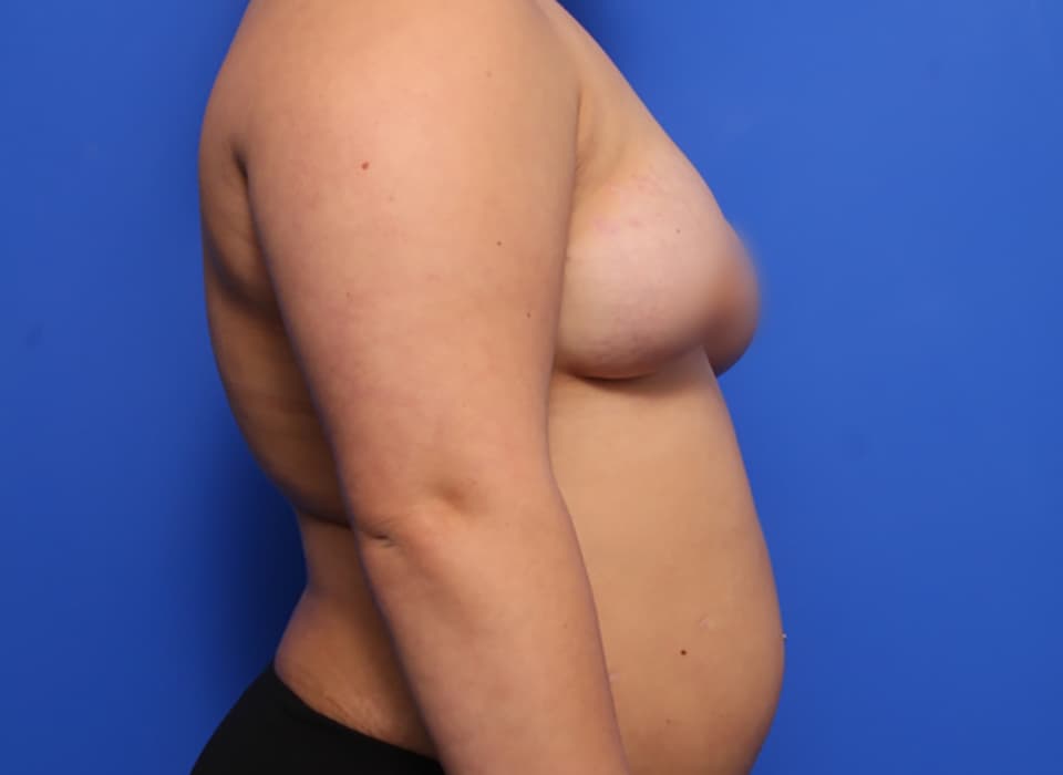 before side view of fat transfer to breast patient