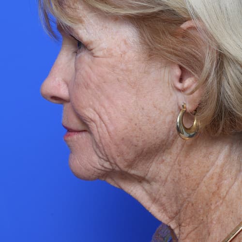 Neck Lift Surgery Columbia MD Baltimore Neck Lift