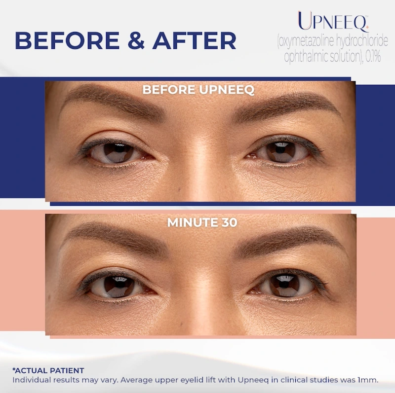 upneeq before and after