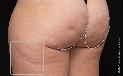 women's buttocks cellulite treatment