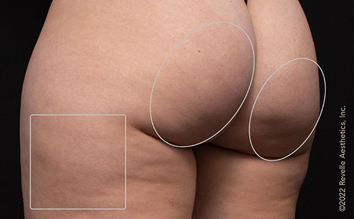 Aveli patient after treatment