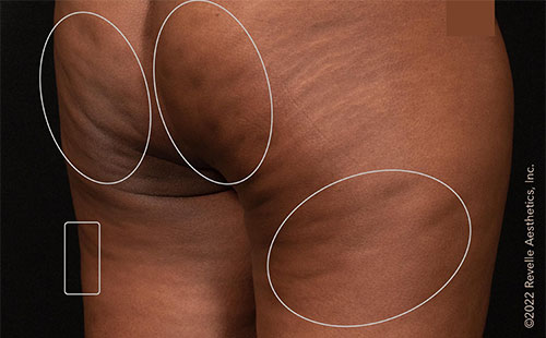 Aveli patient before treatment