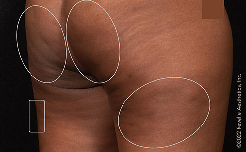 Aveli patient after treatment