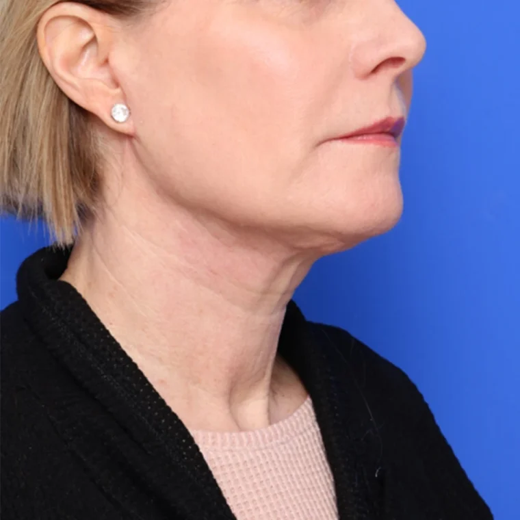 after image