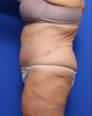 Case # 4 after photo
