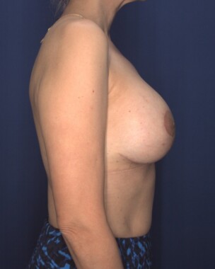 Case # 151 after photo