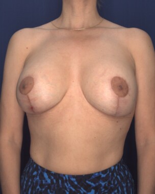 Case # 151 after photo