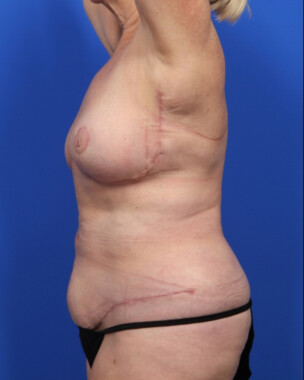 Case # 14 after photo