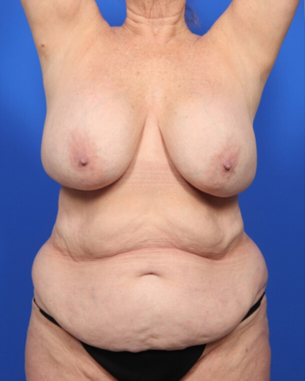 before image