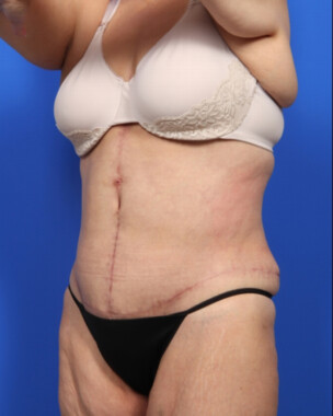 Case # 16 after photo