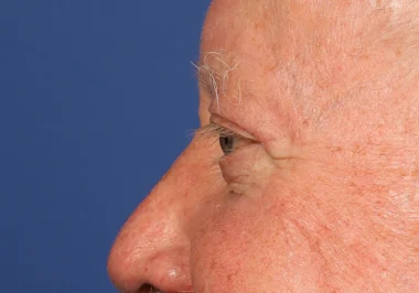 Case # 17 after photo