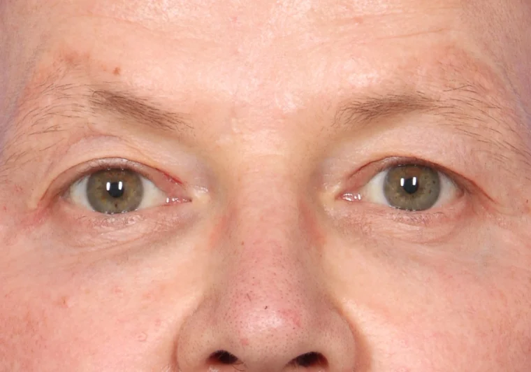 before image
