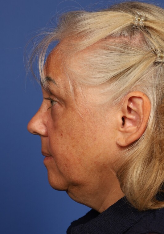 before image